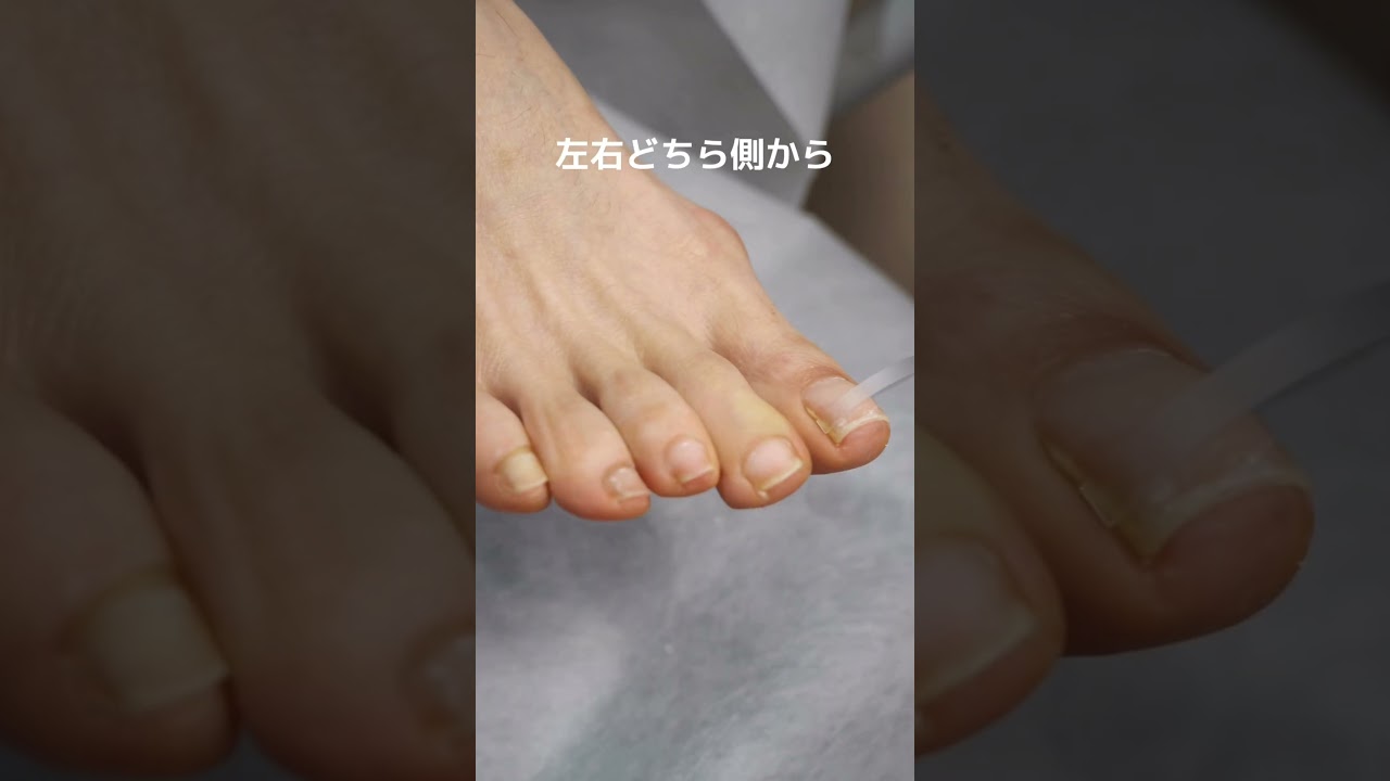 巻き爪ケアフレックスプレート貼る順番 正解は？ #巻き爪矯正 #フレックスプレート