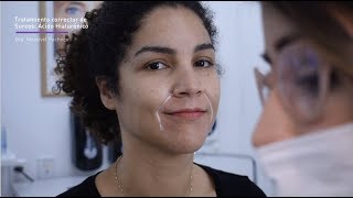 Relleno Ácido Hialurónico Surco Nasogeniano + Marioneta