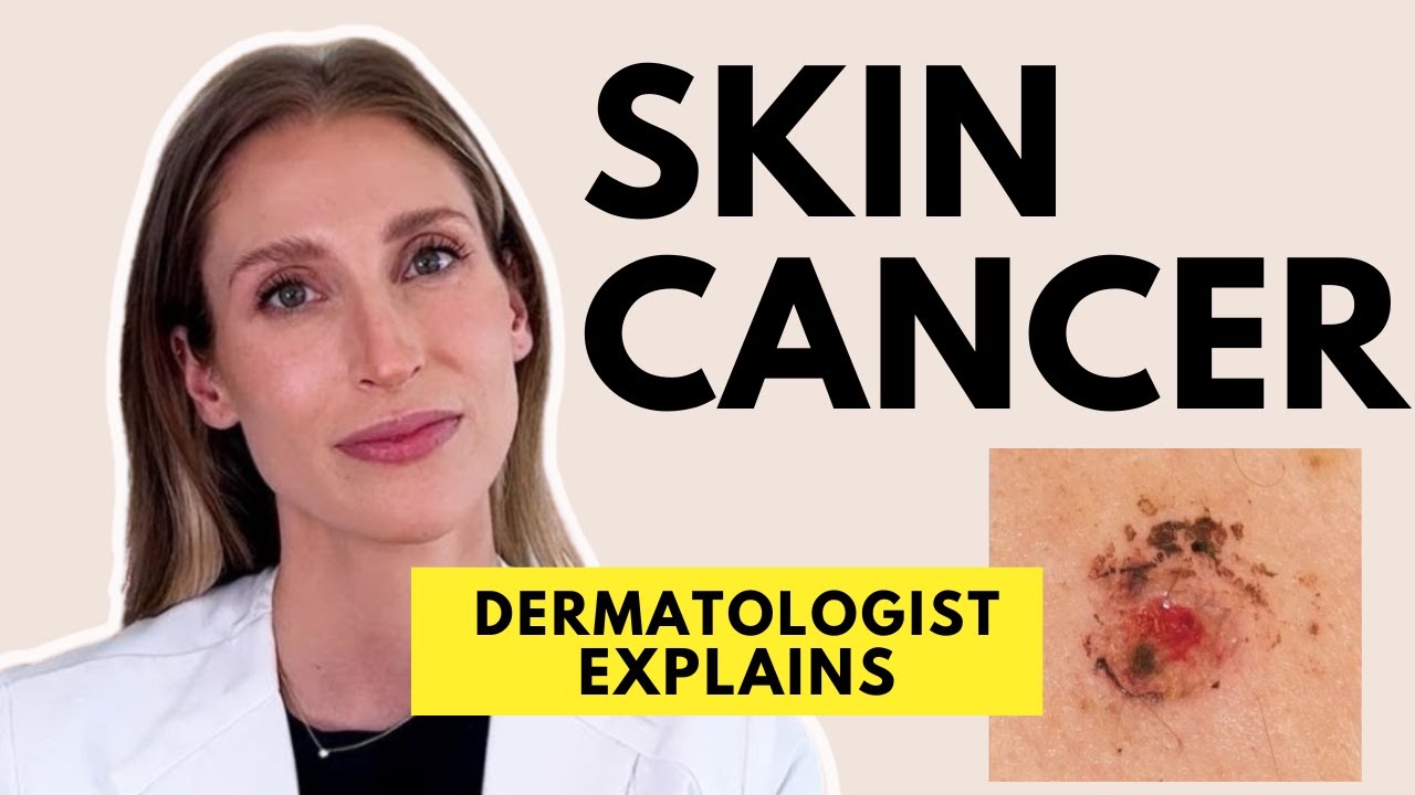 Skin Cancer: Different Types, Causes, Prevention & Treatments | Dr. Sam Ellis