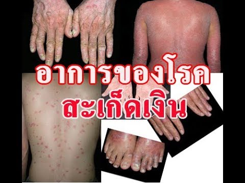 โรคสะเก็ดเงินที่เล็บแพทย์รักษา ไม่ว่าจะเป็นชากลาก