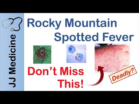 Rocky Mountain Spotted Fever | Bacteria, Signs & Symptoms, Diagnosis and Treatment
