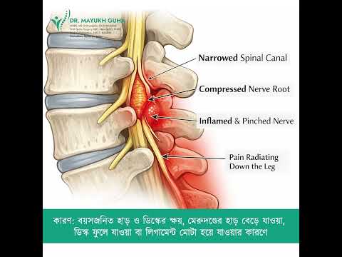 কোমরে ব্যথা ও পায়ে ঝিনঝিনি? সাবধান! হতে পারে স্পাইন বা নার্ভের সমস্যা। - Dr Mayukh Guh