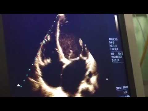 download lagu mp3 mp4 Ecodopplercardiograma Colorido, download lagu Ecodopplercardiograma Colorido gratis, unduh video klip Ecodopplercardiograma Colorido