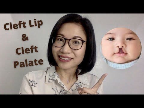 Cleft Lip and Cleft Palate: Causes, Complications, How is it Treated, Prevention | Dr. Kristine Kiat