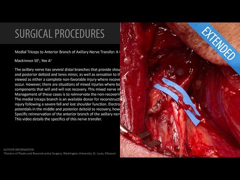 Transfer gałązek nerwu promieniowego unerwiających głowę przyśrodkową mięśnia trójgłowego ramienia do przedniego odgałęzienia nerwu pachowego: przypadek specyficznej rekonstrukcji unerwienia (z udziałem Dr Mackinnon) - dłuższa wersja