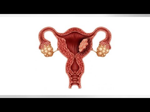 Endometrium rák elhízás