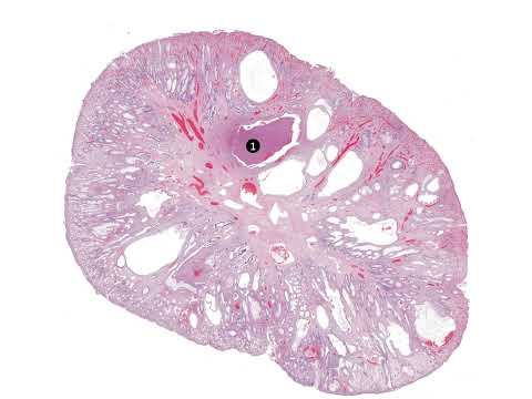 Juvenile polyp