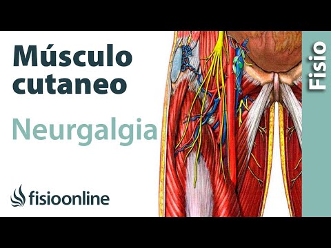 , title : 'Neuralgia del nervio femorocutáneo en el muslo - Qué es, causas, síntomas y tratamiento'