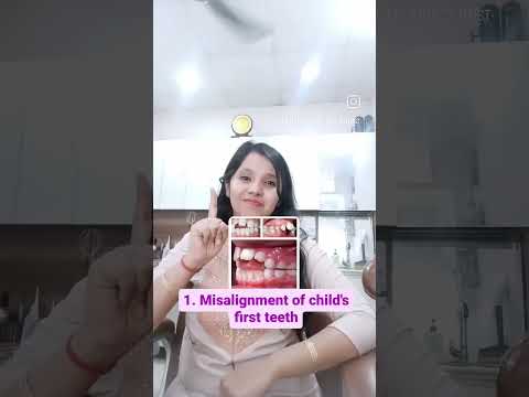 Pacifier in babies and it's effects on teeth