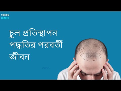 চুল প্রতিস্থাপনের পরবর্তী জীবন