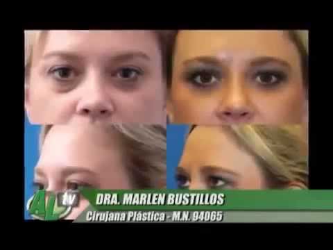 Blefaroplastía
