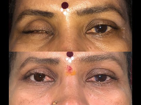 Artificial Eye - Prosthetic Eye - Patient with Ocular Prosthetics