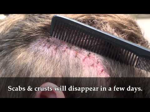 Patient 18 Undetectable Scar: 10 day