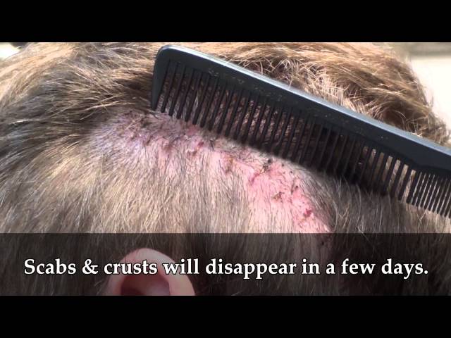 Patient 18 Undetectable Scar: 10 day