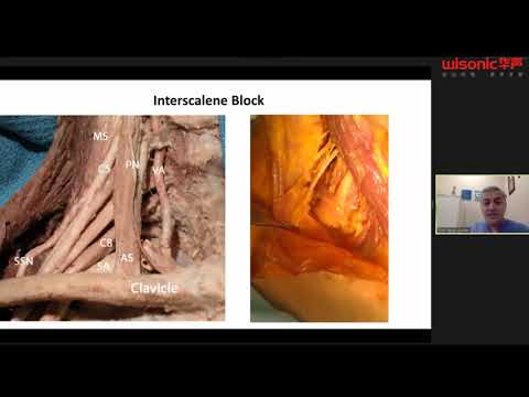 Upper Extremity Blocks: Current Insights
