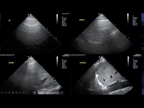 Normotensive Cardiogenic Shock