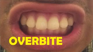 how to fix an overbite without braces
