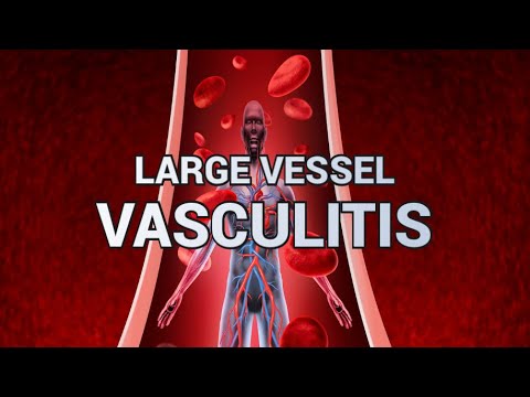 Large Vessel Vasculitis - CRASH! Medical Review Series