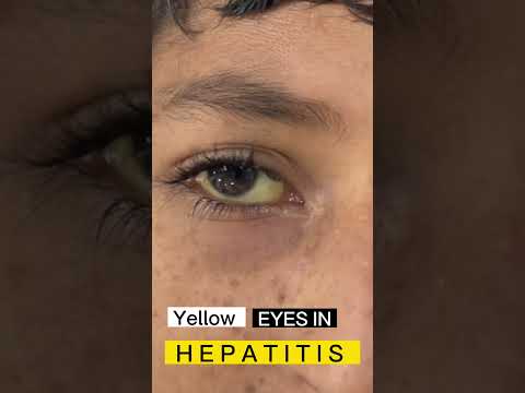 Yellow eyes #jaundice #sign #sclera