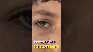 Yellow eyes #jaundice #sign #sclera