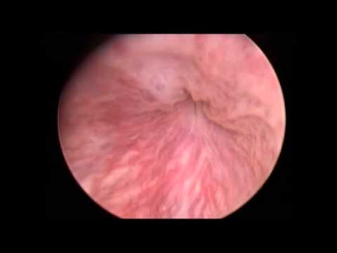 Exazerbation der Prostatitis Antibiotika 4 Prostatakrebs Stufe, aus dem die Matrize