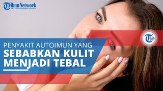 Scleroderma, Penyakit Autoimun Menyerang Jaringan Ikat dan Sebabkan Penebalan pada Kulit dan Organ