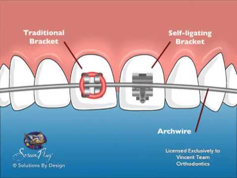 Vincent Team Orthodontics Self-Ligating Braces