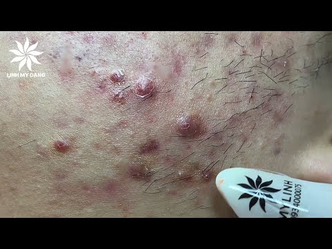 Pimples Videos 2022