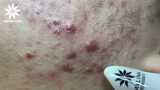 Relaxing Acne Treatment #7 | Inflamed Acnes