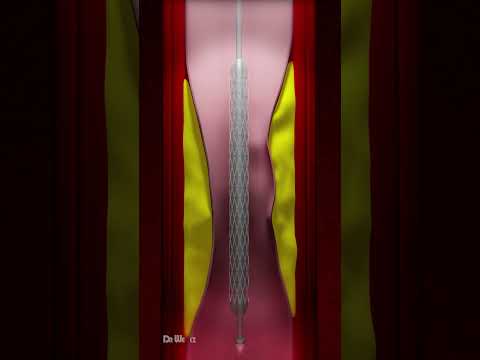 Coronary Artery Stent Placement (Animation)