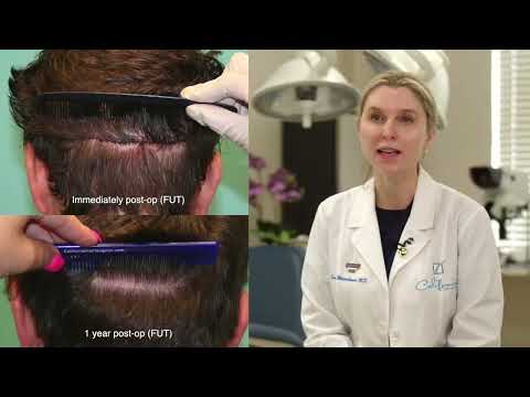 FUT or Strip Harvest Hair Transplant | When FUT is...