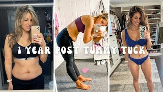 1 Year Tummy Tuck Journey Before & After Transformation, answering frequently asked questions!