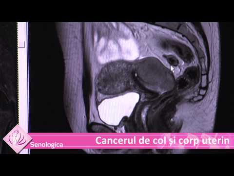 Cause of colorectal cancer