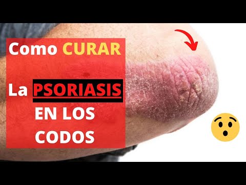 Como se ve el hongo de las uñas en las manos la fase inicial de la foto El ungüento del hongo de la piel de las planta