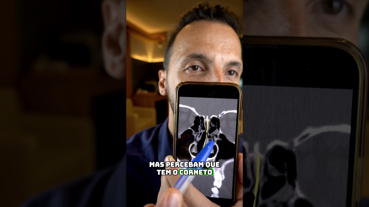 Desvio de septo: precisa operar ou não? Descubra a verdade!