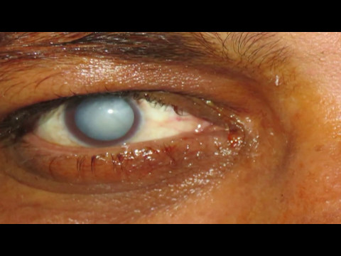 Cataract Surgery with Implantation of Trifocal Lens