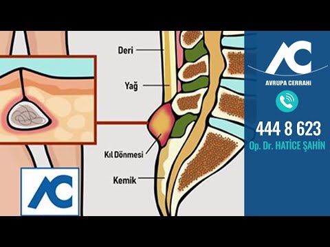 Kıl Dönmesi Apsesi ve Kıl Dönmesi Tedavisi