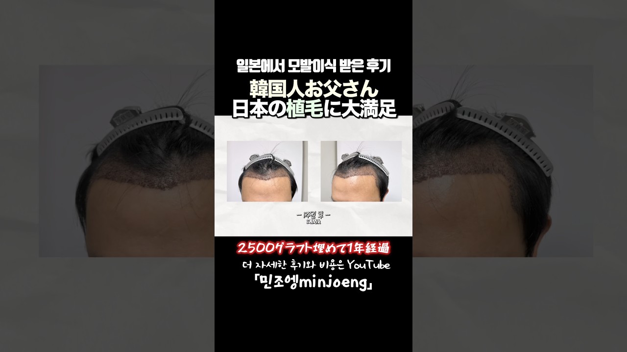 일본 모발이식 1년 후기