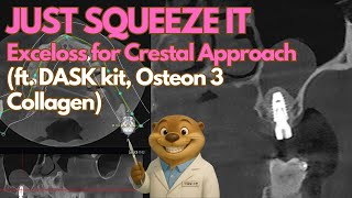 Super Simple Crestal Approach using Exceloss (Ft. DASK kit, Osteon 3 collagen)