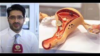 هبوط الرحم كيف يحدث وما هي أهم أسبابه وعلاجه