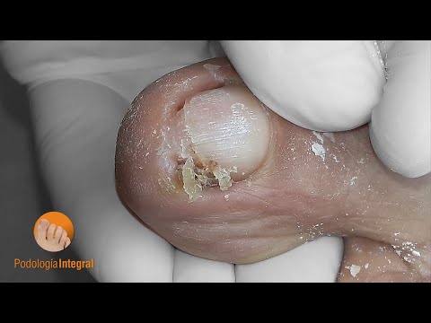 Que medios del hongo más vale La fase inicial del hongo sobre las uñas de los pies