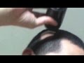 Alopecia Areata Bald Spot for Male: How to Hide ...