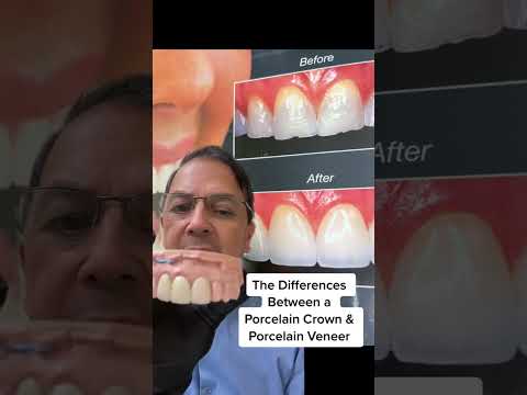 Porcelain Dental Crowns vs Porcelain Dental Veneers (WHAT'S THE DIFFERENCE?!) | View Mobile Dental