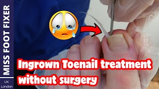 Ingrown Toenail Treatment Without Surgery By Miss Foot Fixer