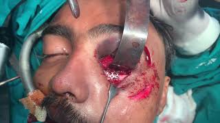 Riding without helmets? Messed up face fixed bit by bit like a jigsaw puzzle by maxillofacial surgen