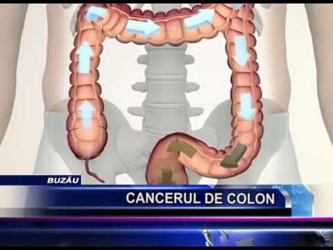 Colon cancer abdominal fluid