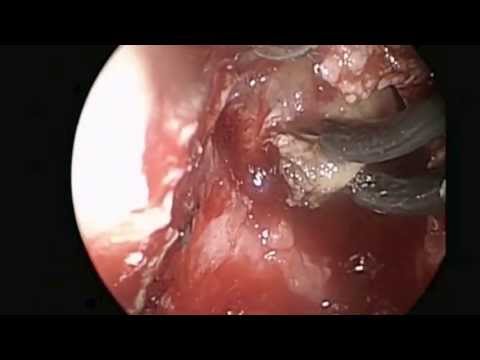 Endoskopowe wewnątrznosowe zaopatrzenie płynotoku nosowego z przepukliną mózgową
