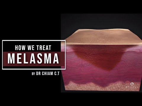 Mein 4-Schritte-Ansatz zur Behandlung von Melasma | Dr. Chiam Chiak Teng
