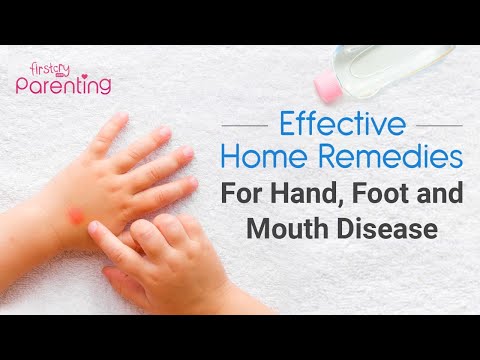 8 effective home remedies for hand, foot, and mouth disease in children