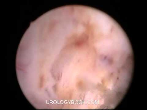 Holmium Laser Enucleation Of Prostate 8/9